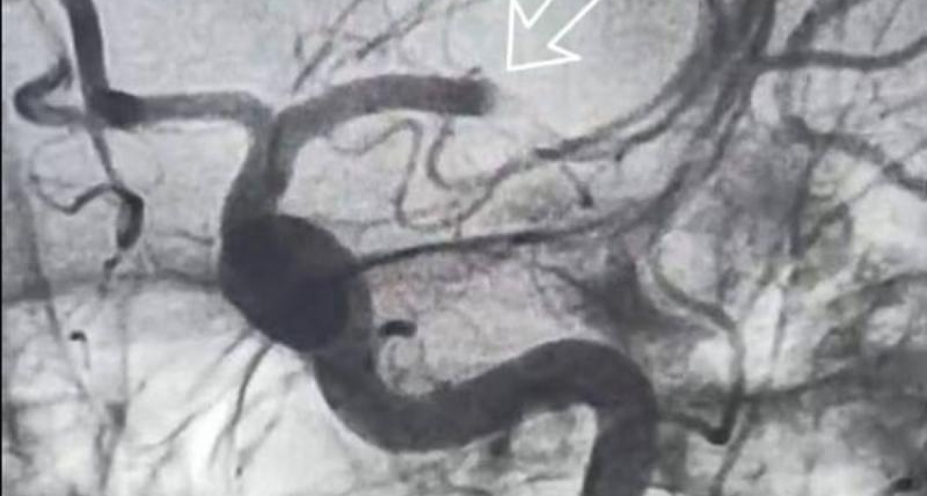 74-летняя пенсионерка заговорила прямо на операционном столе после извлечения тромба из мозга