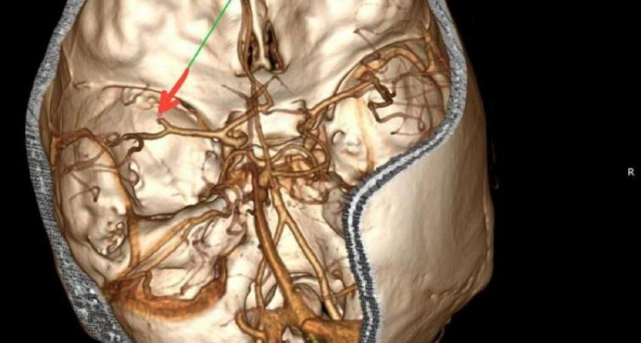 Речь пропала, рука отказала: 35-летняя воронежка получила инсульт прямо на рабочем месте